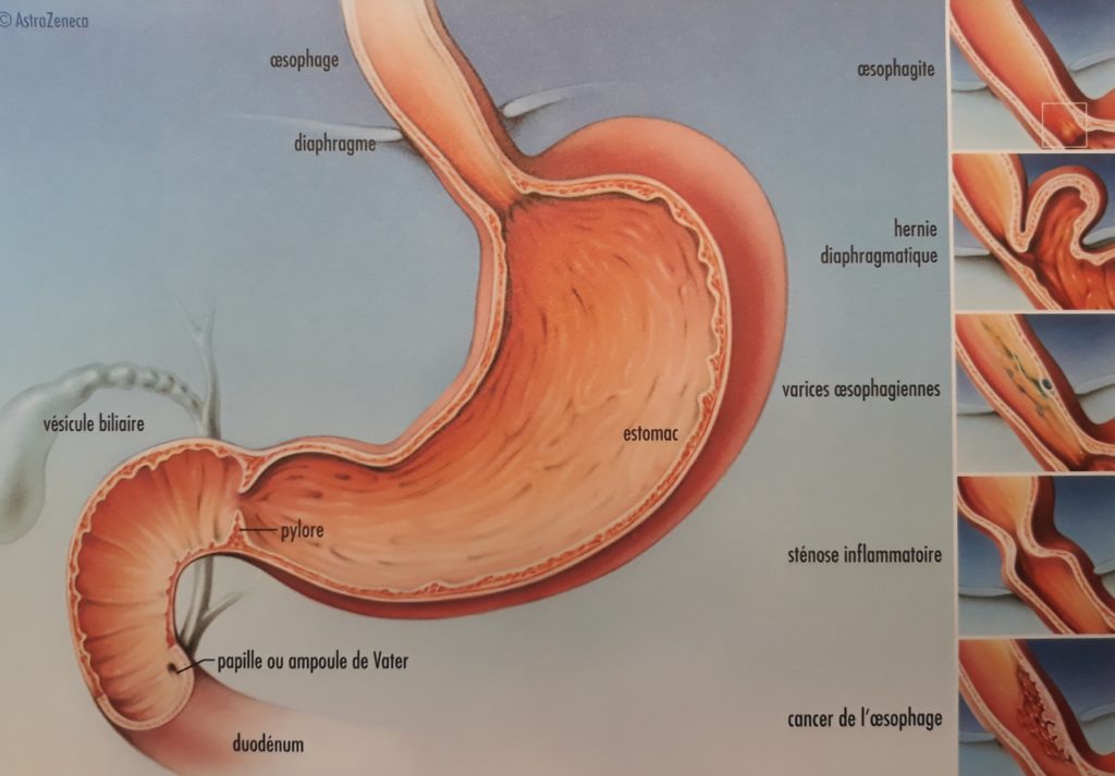Chirurgie de la hernie hiatale