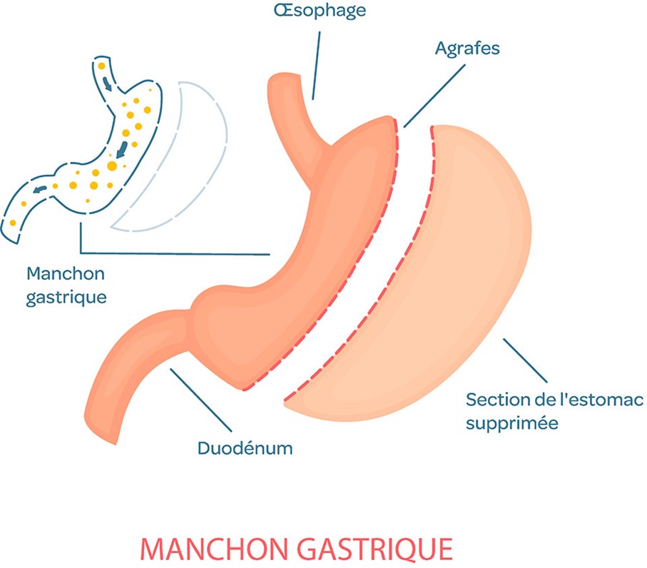 Sleeve gastrectomie