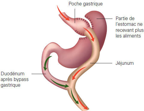 Bypass gastrique