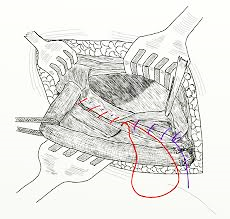 Suture directe